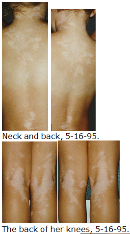 vitiligo back and legs