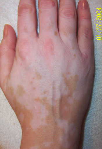 nathalie pelletier vitiligo right hand january 2004