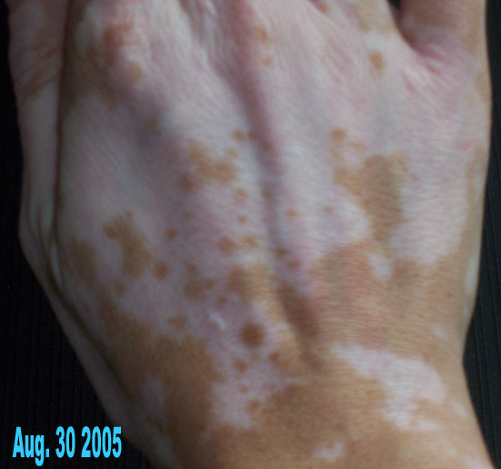 nathalie pelletier vitiligo right hand aug 2005