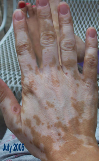 nathalie pelletier vitiligo right hand july 2005