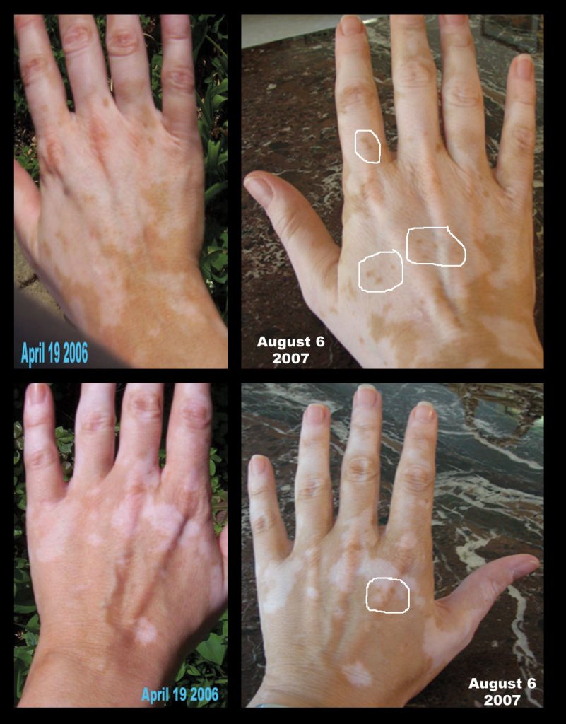 nathalie pelletier vitiligo healing