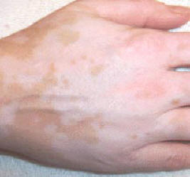 vitiligo cover lotion photo of results before application