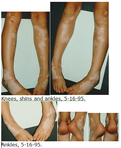 vitiligo legs feet
