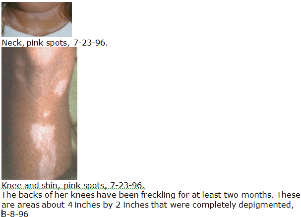 repigment vitiligo