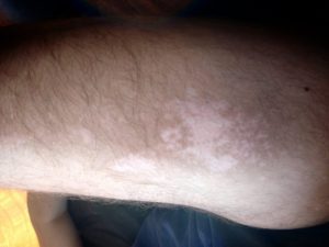 vitiligo with repigmentation