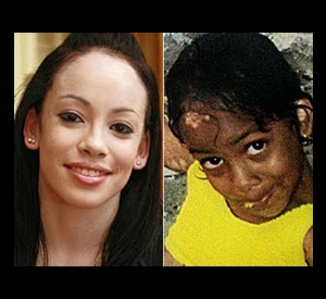 Darcel de Vlugt,vitiligo,vitiligo photo