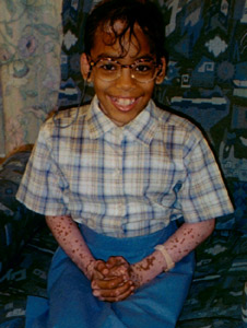 darcy,vitiligo photos