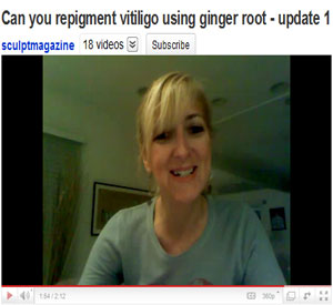 vitiligo repigmentation ginger-root-experiment