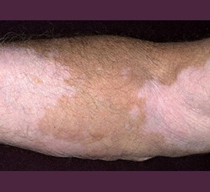 vitiligo, iran, royan cell therapy