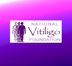 nvfi-vitiligo