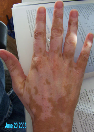 nathalie pelletier vitiligo right hand july 2005