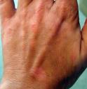 xtrac vitiligo treatment left hand, nathalie pelletier