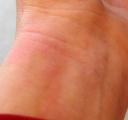 xtrac vitiligo treatment left wrist, nathalie pelletier
