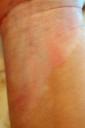 xtrac vitiligo treatment right wrist, nathalie pelletier
