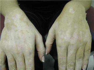 excimer xtrac laser treatment vitiligo, nathalie pelletier