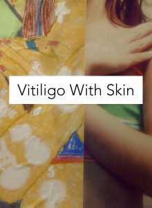 Vitiligo Model 