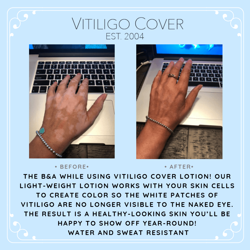 Vitiligo Cover Before and After