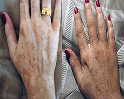vitiligo cover really works