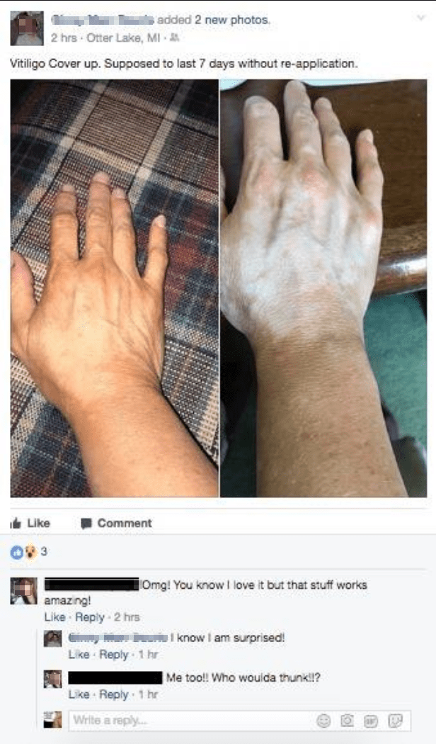 vitiligo cover lotion facebook