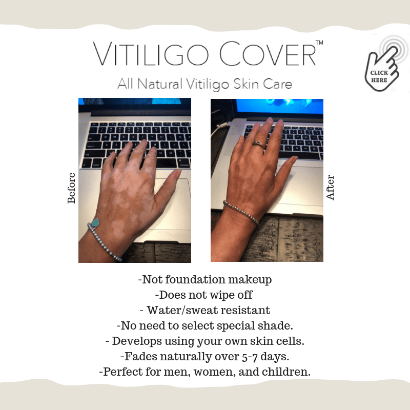 vitiligo cover lotion reviews 2018
