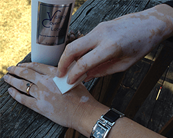 use-vitiligo-cover