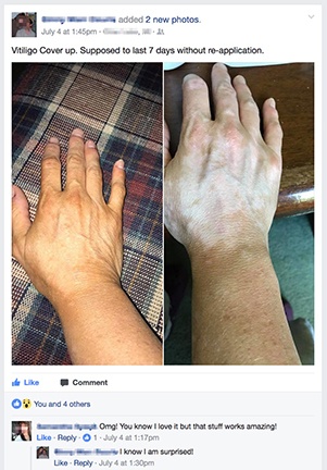 vitiligo-cover-lotion-facebook