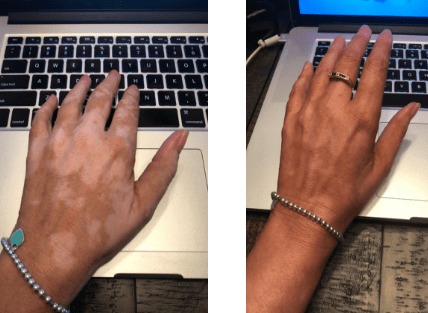 vitiligo cover lotion results 2018